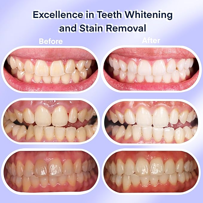 American Teeth Whitening Kit, Teeth Whitening Gel, Pen, Whitening Trays with Light, 25 Uses, Whiten Up to 8 Shades in 1 Week, 2025 Powerful Teeth Whitener